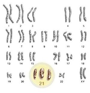 El cromosoma 21 humano (HSA21)